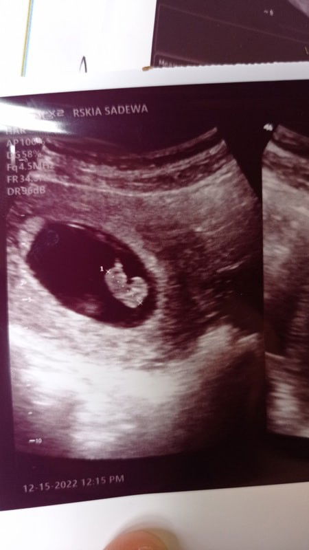 Hamil 10w janin tidak berkembang tanpa ada flek dan kram perut