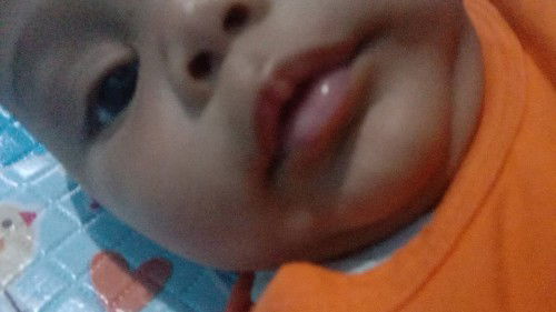 Bercak putih pada muka bayi