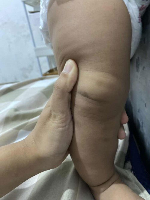 Menghilangkan bekas gigitan serangga