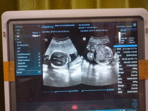 USG 22w tapi posisi sungsang?