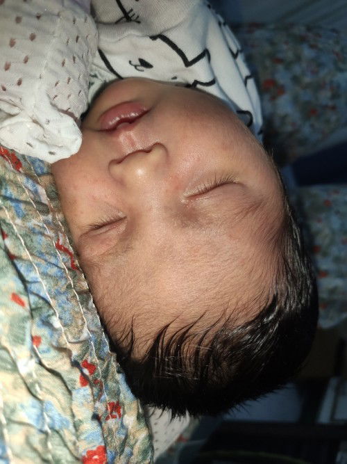 Baby acne po ba eto?