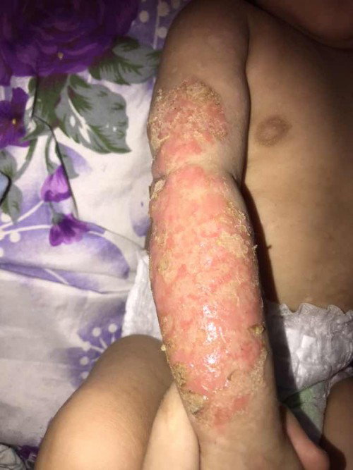 Luka pada tangan bayi 5 bulan