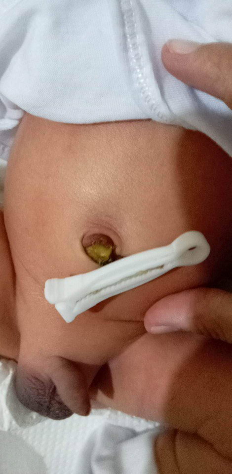Umbilical cord