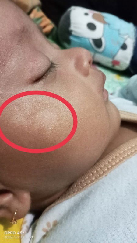 Cara ngilangin belang