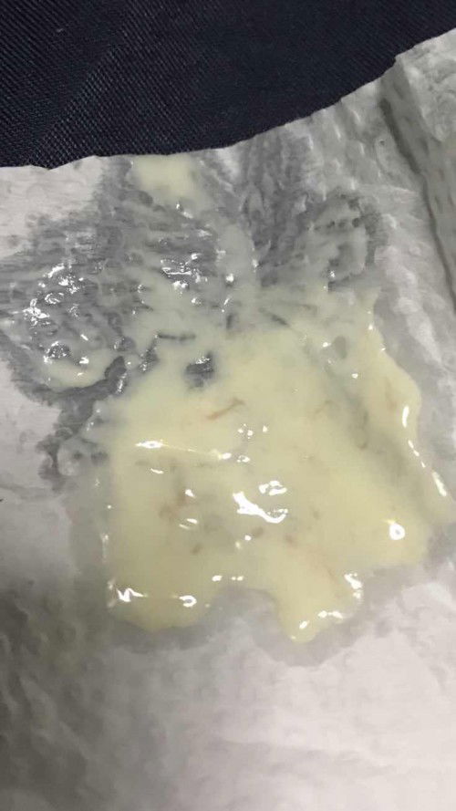 YEAST INFECTION PREGNANT