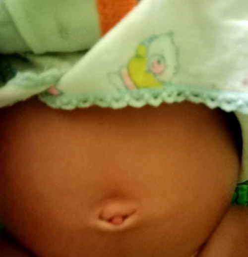Ada yang menonjol sedikit di pusar bayi usia 2 bulan