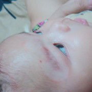 Bekas cradle cap supaya ga belang2 gimana ya ?