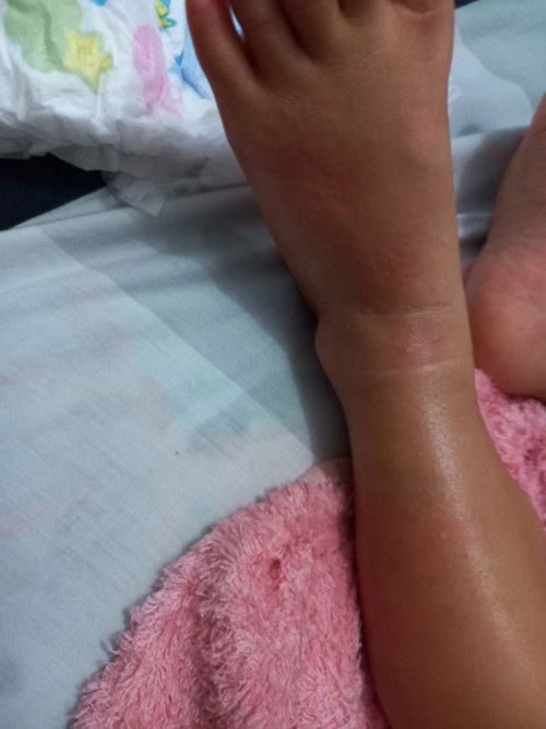 Bintik bintik anak 1thn ini pakai apa y bun ilangin nya?