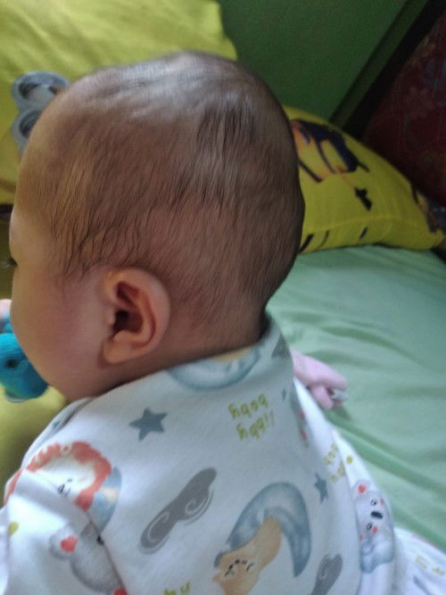 Kepala belakang tidak rata