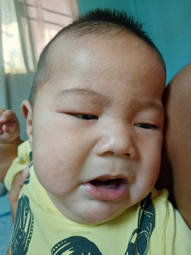ผิวหน้าน้องแห้ง ลอก