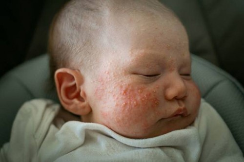 Baby Acne / Jerawat