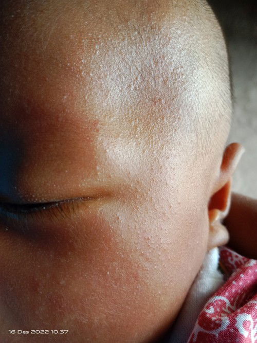 Bund muka dedek muncul bintik-bintik kayak gini, ini biang keringat atau apa ya bund?