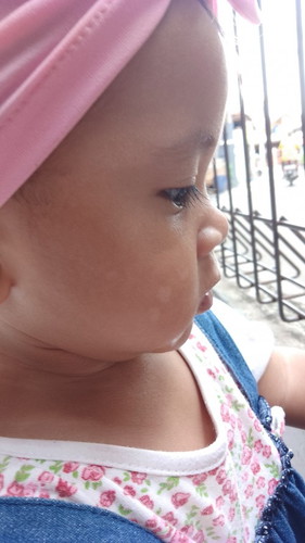 Putih putih d wajah bayi gimana ngilanginya bunda ky panu