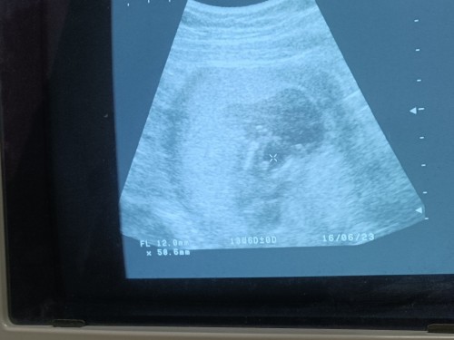 14week แม่ๆรู้เพศกันยังคะ