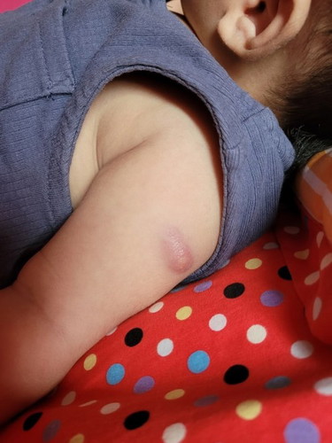 Kesan bengkak suntikan vaksin baby.