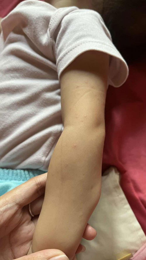 Tubuh bayi berbintik merah