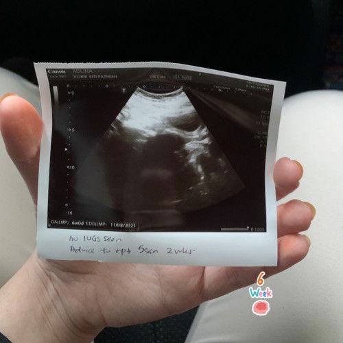 6weeks normal ke tak nampak kantung lagi?