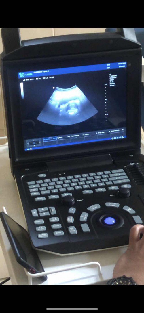 hamil 12week hasil usg kosong