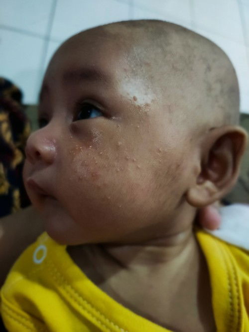 Bintik bintik macam jerawat