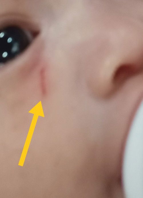 How to Remove Baby Scar on face?