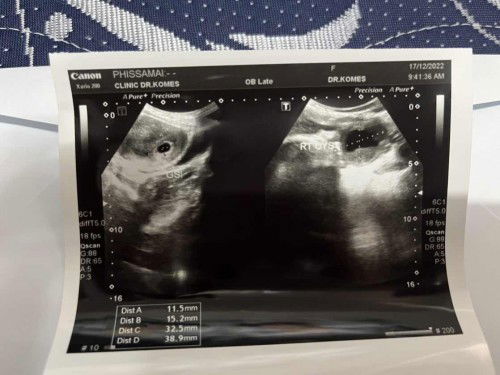 มีใครเคยเป็นซีสมั๊ยคะ