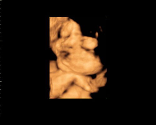 Hasil usg bayi saya bund kalo kata dokter sedang mangap tapi saya kepikiran apakah normal normal aja