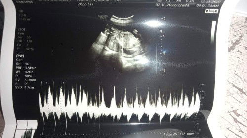 My 1st Ultrasound