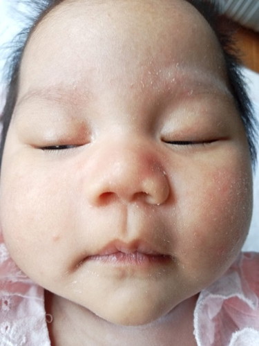 ลูกแม่ๆคนไหนหน้าลอกแบบนี้บ้างคะอยากถามว่าใช้อะไรถึงจะหายสาเหตุเกิดจากอะไรคะ