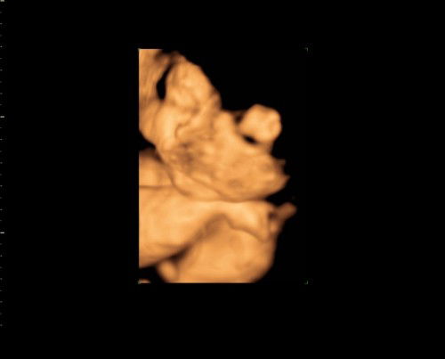 Hasil usg bayi saya bund, tidak terlalu terlihat jelas bagian bibir nya menurut bunda apakah normal?