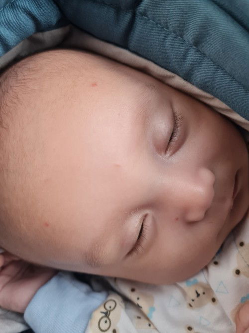 Bintik merah di muka bayi