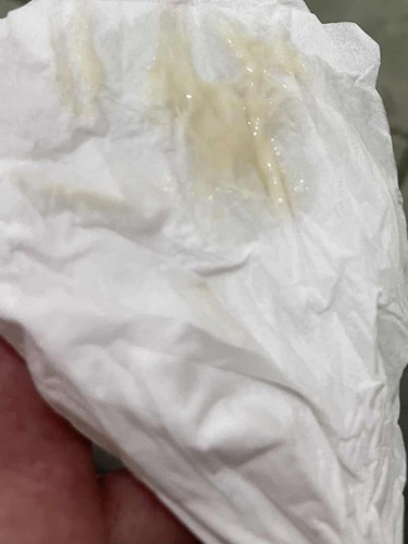 Discharge or mucus plug?