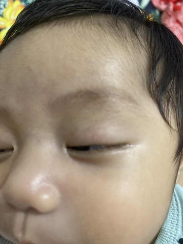 PULANG UGAT SA TALUKAP NG MATA