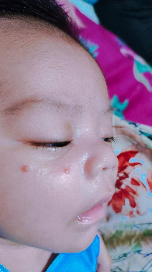 Wajah bayi timbul seperti jerawat