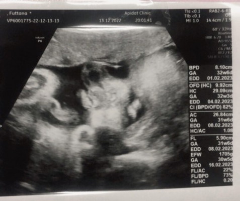 32 week+2 ลูกชายคนที่2