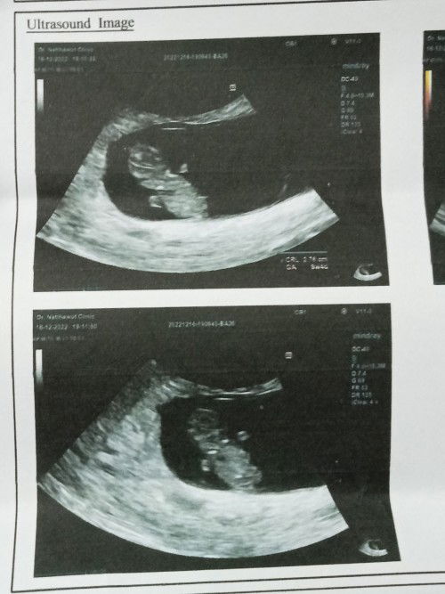 ไปฝากครรภ์หมอซาวผ่านช่องคลอดตั้งครรภ์  9W2D ลุ้นมากดีใจมากหมอบอกได้ลูกชายหลังจากนั้นคำที่พูดยากหมอมา