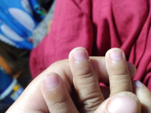 Normal lng po ba kulay ng kuko ng anak ko worried lng po ko ..