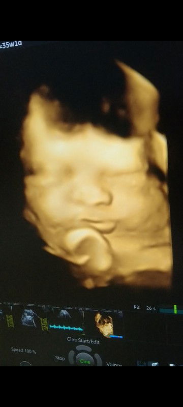 masya allah hasil usg kmrn