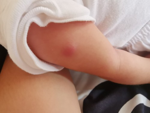 Hi, baka may same experience skin dto, ano po kaya itong nasa braso ng baby ko 🥺😭