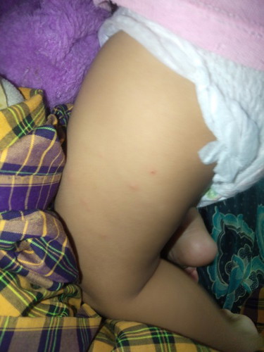 Muncul bintik bintik pada paha anak usia 11bulan