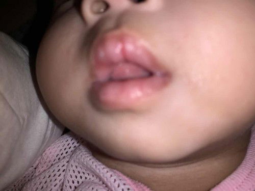 Bibir baby merekah luka kering