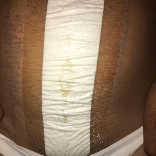 แผลผ่าตัดคลอด