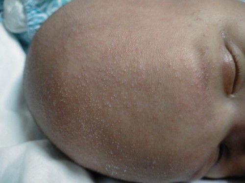 ruam, produk apa yang sesuai?