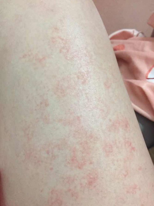 Các mom cho em hỏi chân em bị như này là bị rạn hay do bị gì ạ