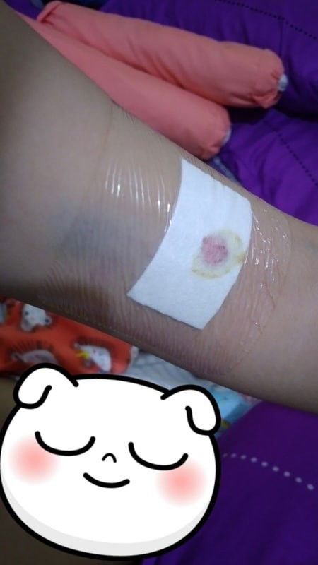 post pasang KB Implan