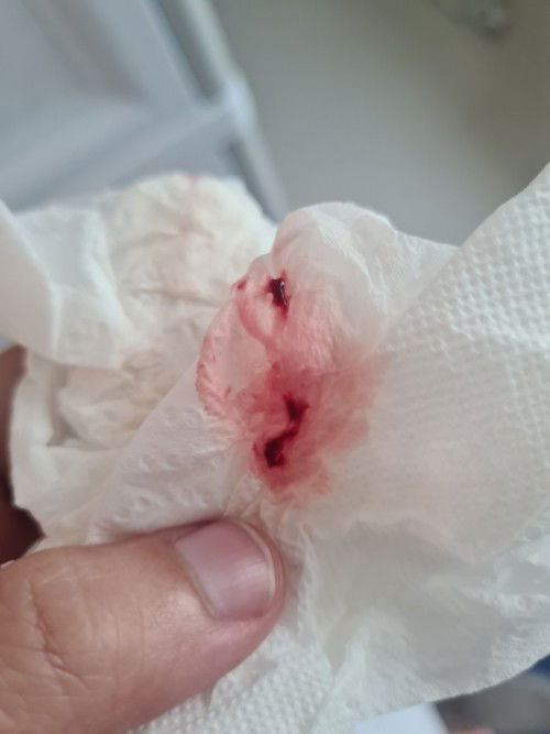 เมื่อวานมีเลือดออกตกใจมาก คล้ายมูก ไปหาหมอหมอว่าปกติดี เลยให้ยากันแท้งมา แต่วันนี้ไม่มีอาการแพ้ท้อง