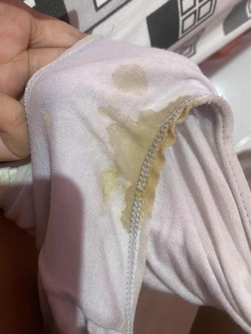 keputihan/flek kuning