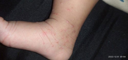 kaki bintik bintik merah