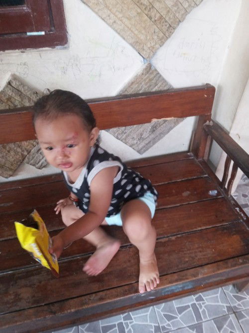 Ada jerawat di wajah anakku usia 1th 11 bulan