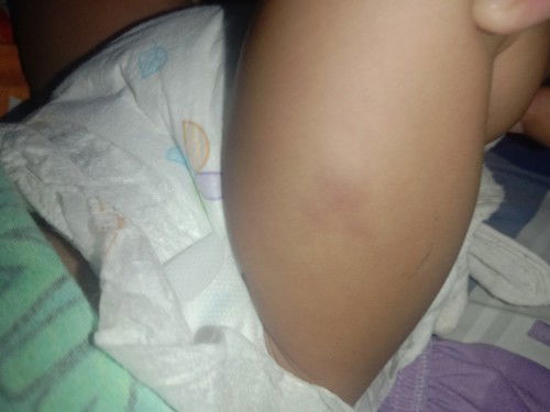 Nag pa immunize si baby nung dec 14 tapos hanggang ngayon may prang pasa pa pang 5 days na po ngayon