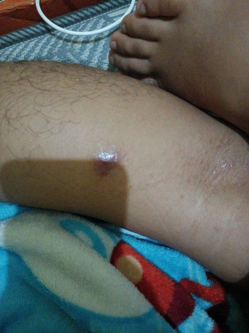 Batu empedu dan Liver